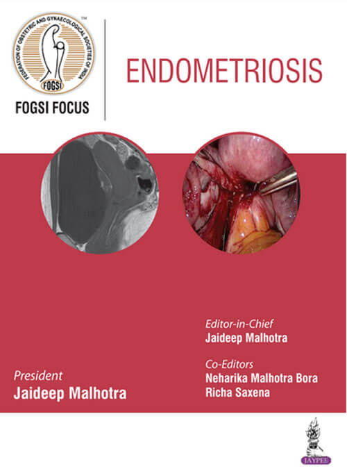 FOGSI Focus Endometriosis